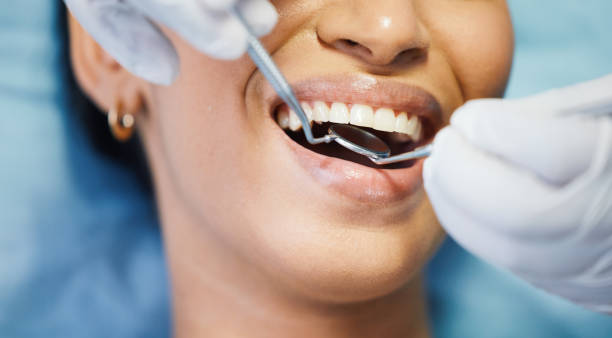 Best Knocked-Out Tooth (Avulsed Tooth) Treatment in Daleville, IN