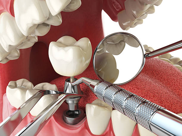 Best Emergency Denture Repair in Daleville, IN